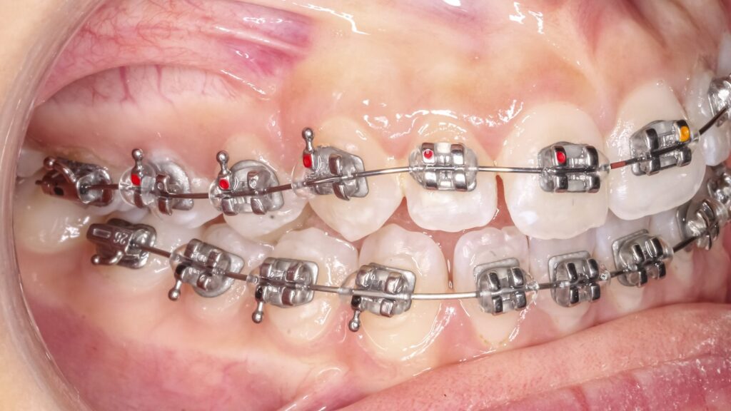 Close-up of fixed braces on both dental arches – a complex case where braces may suit better than Invisalign
